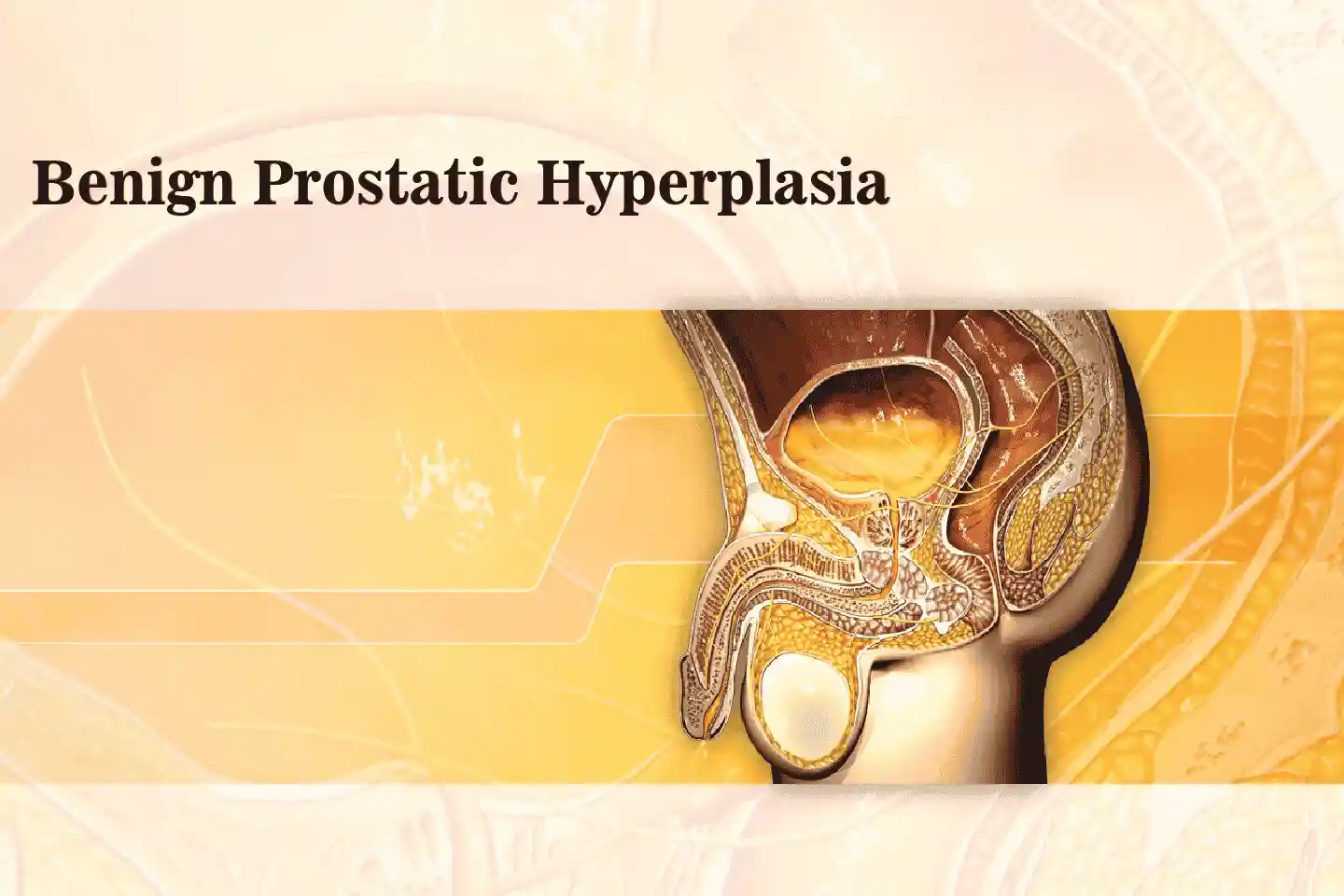 Benign Prostatic Hyperplasia